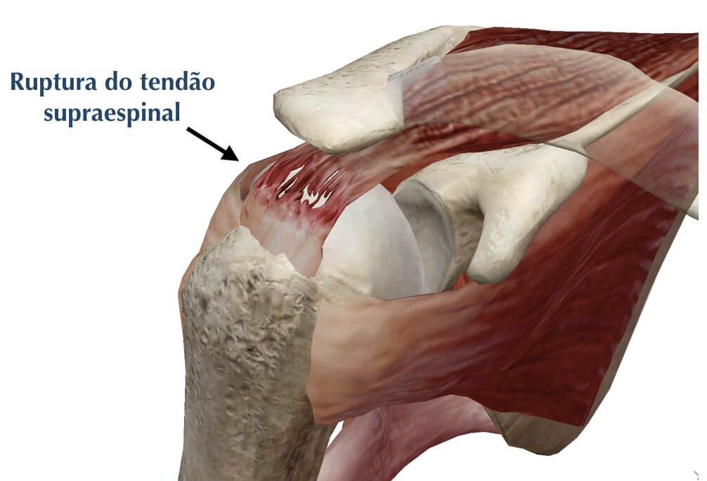 Tendinopatia no ombro e trabalho: causas, direitos e como se proteger